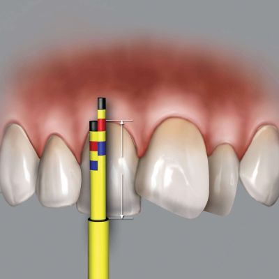 Inline Replacement Tips (3 Tips)